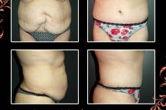 abdominoplasty-6368