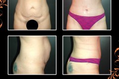 abdominoplasty-6373