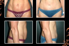 abdominoplasty-6375