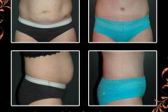 abdominoplasty-6391