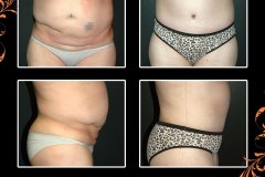 abdominoplasty-6393