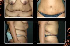 abdominoplasty-6453