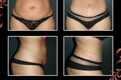 abdominoplasty-6467