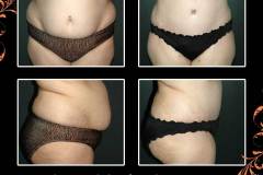 abdominoplasty-6523