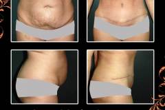abdominoplasty-6524