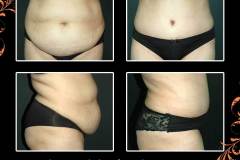 abdominoplasty-6531