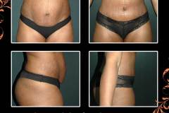 abdominoplasty-6543
