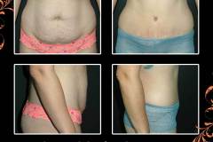 abdominoplasty-6546