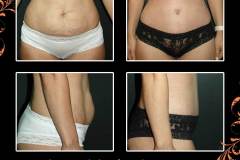 abdominoplasty-6551