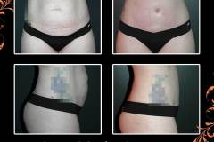 abdominoplasty-6579