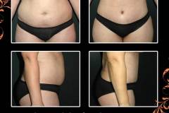 abdominoplasty-6593
