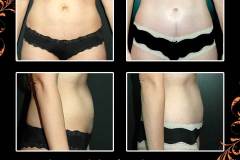abdominoplasty-6631