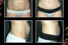 abdominoplasty-6634