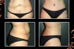 abdominoplasty-6636