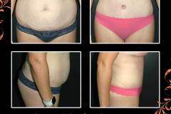 abdominoplasty-6699