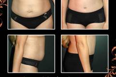 abdominoplasty-6742