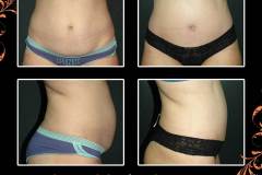 abdominoplasty-827