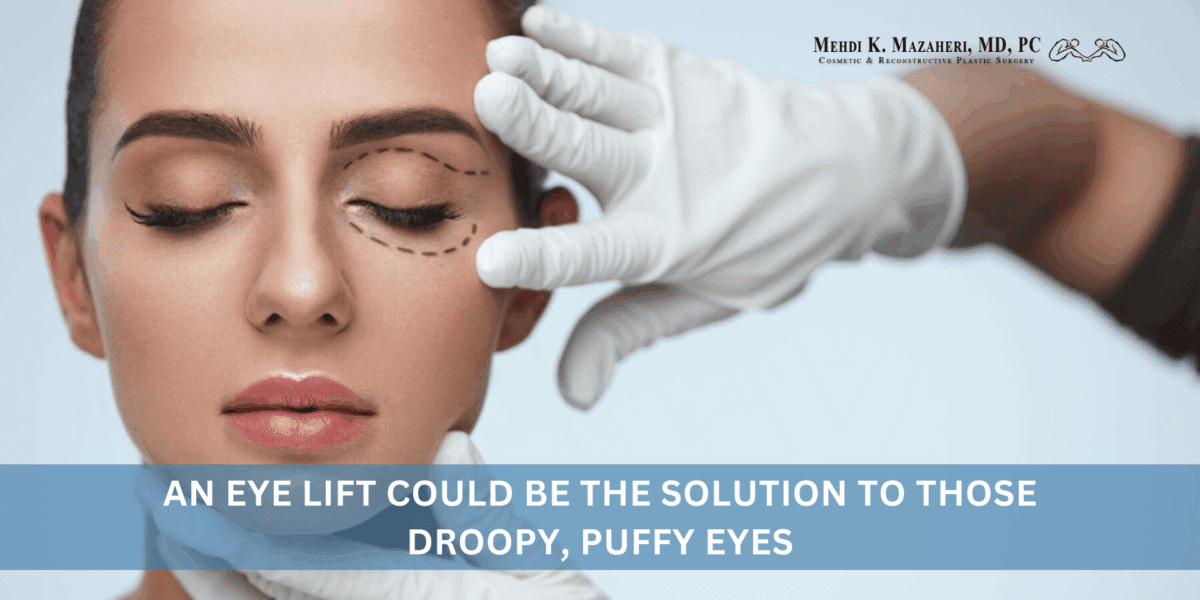 An Eye Lift Could Be the Solution to Those Droopy, Puffy Eyes