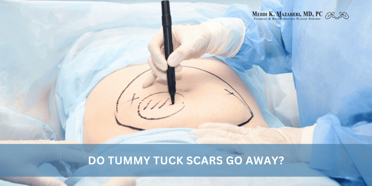 Do Tummy Tuck Scars Go Away?