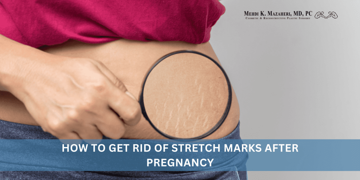 How to Get Rid of Stretch Marks After Pregnancy