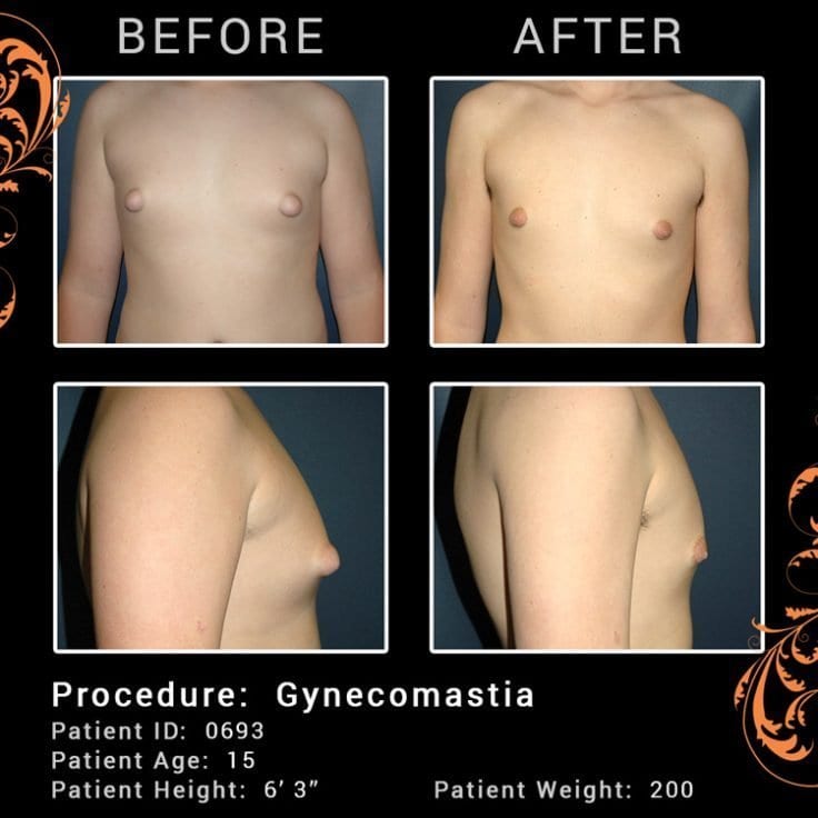 gynecomastia before and after pic of patient
