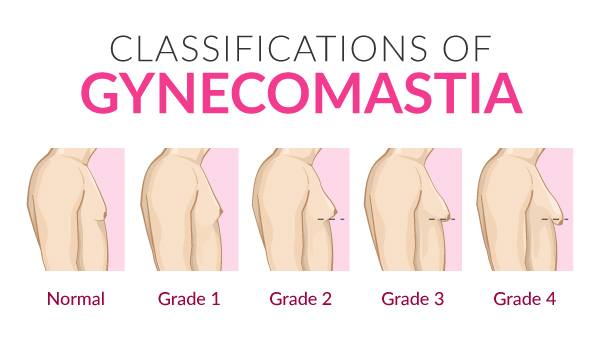 classification-of-gynecomastia