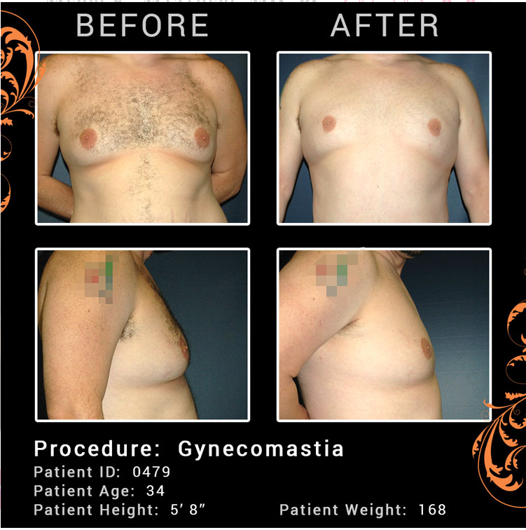 How to tell if you have Gynecomastia?