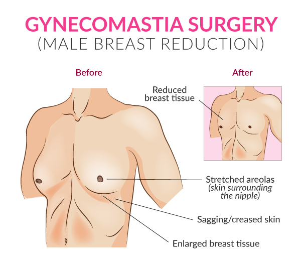 Causes of Male Breast Pain and Swelling