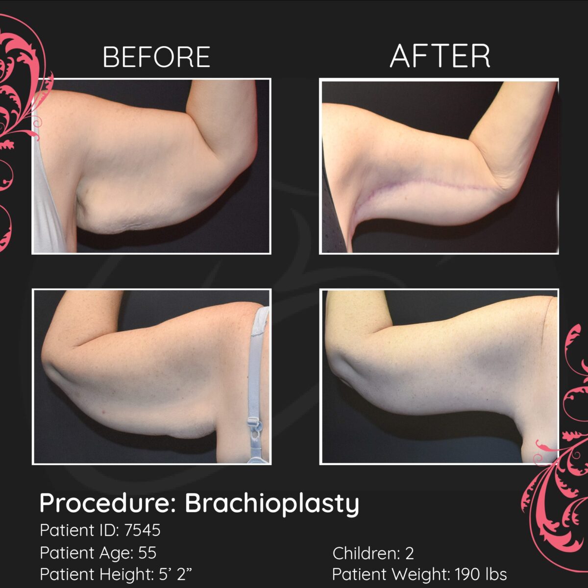 before-after-Brachioplasty