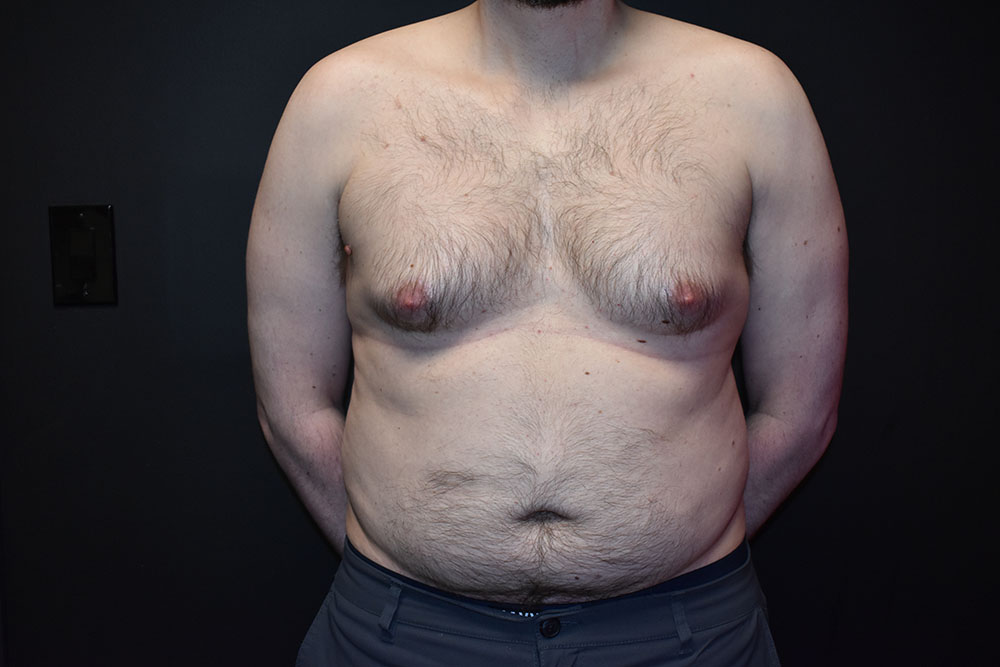 What Is Gynecomastia Surgery