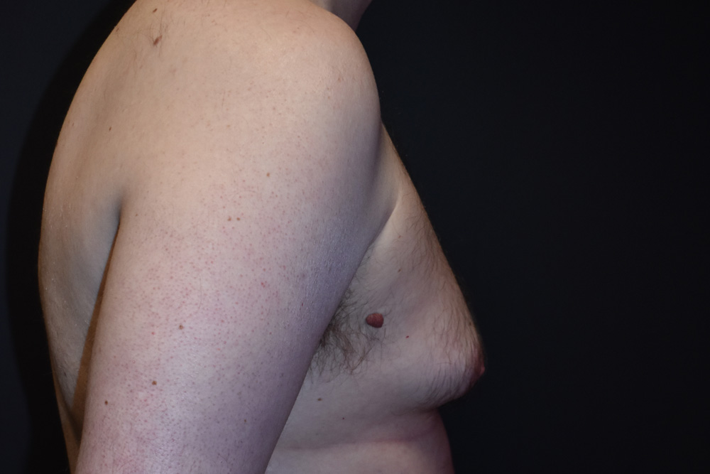 enlarged male breasts