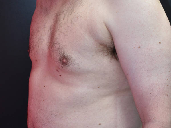 Male boobs Gyencomastia