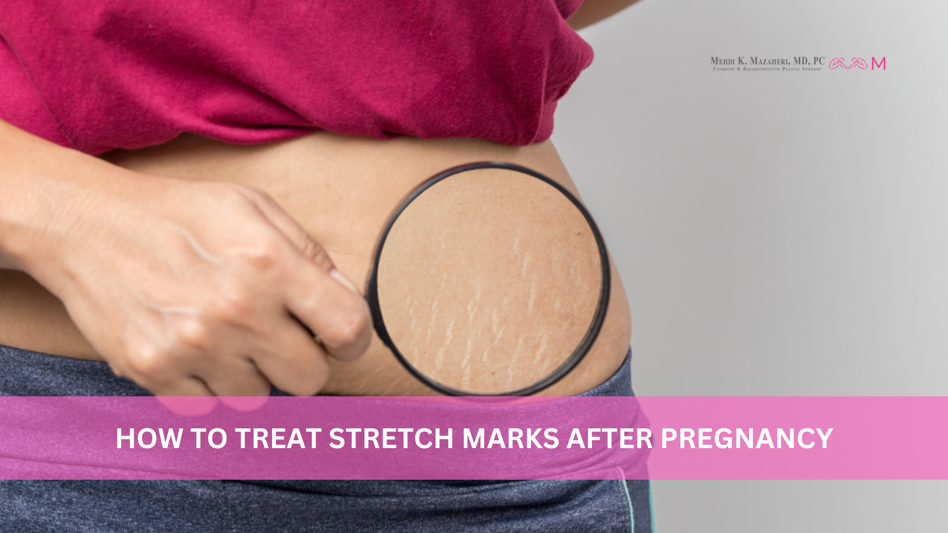 How to Treat Stretch Marks After Pregnancy